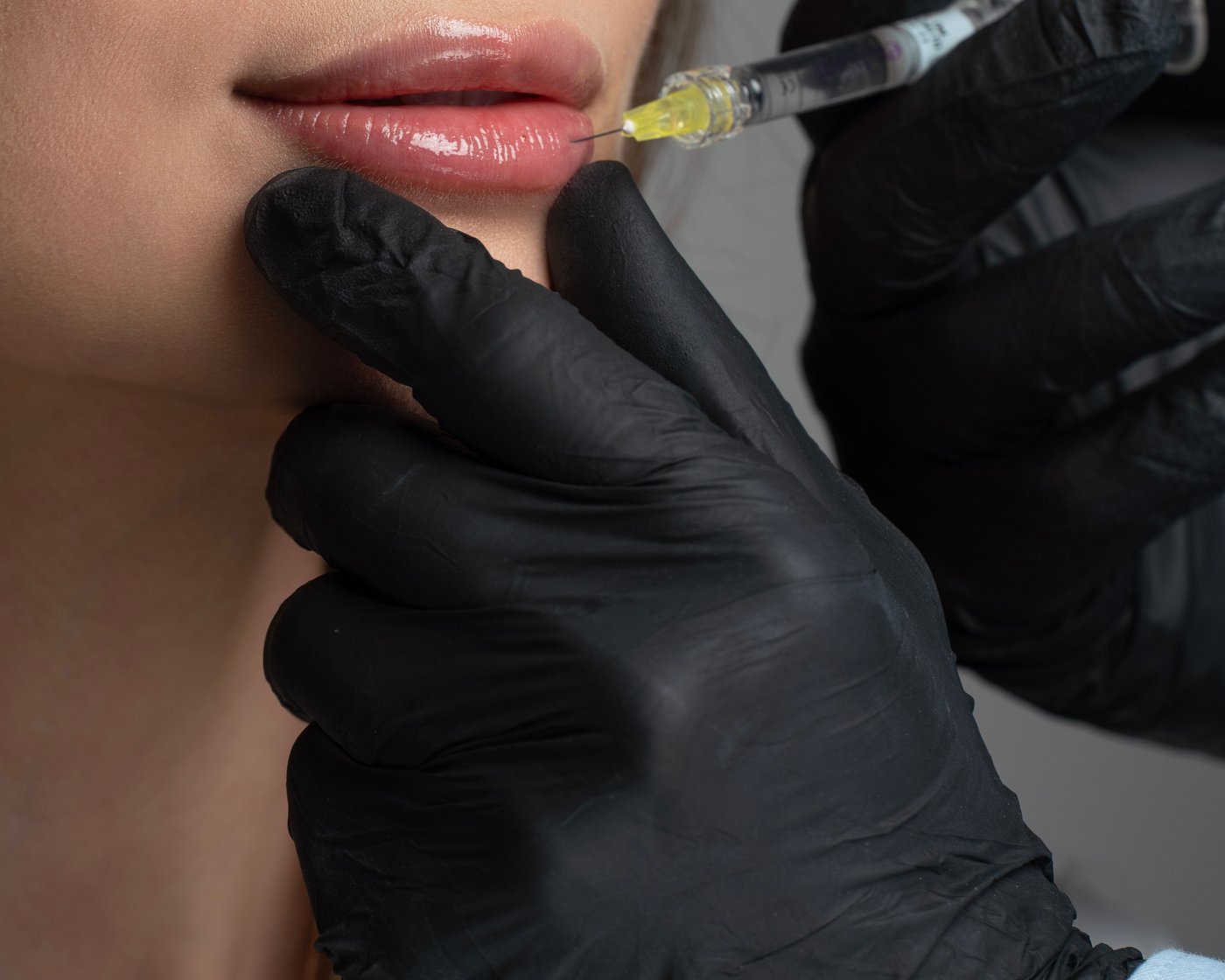 Dermal filler treatment